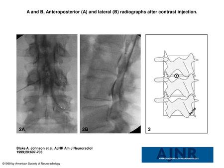 A and B, Anteroposterior (A) and lateral (B) radiographs after contrast injection. A and B, Anteroposterior (A) and lateral (B) radiographs after contrast.