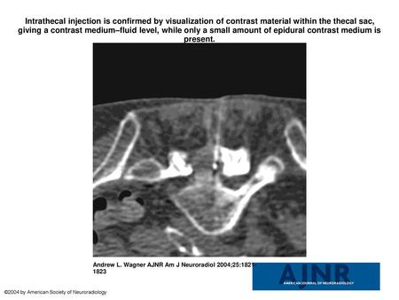 Intrathecal injection is confirmed by visualization of contrast material within the thecal sac, giving a contrast medium–fluid level, while only a small.