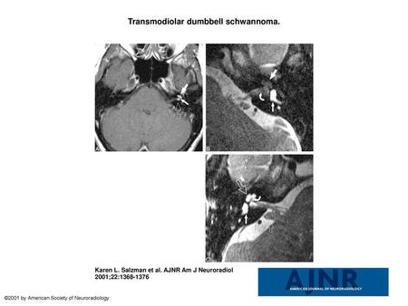 Transmodiolar dumbbell schwannoma.