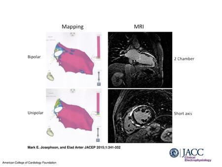 Mark E. Josephson, and Elad Anter JACEP 2015;1: