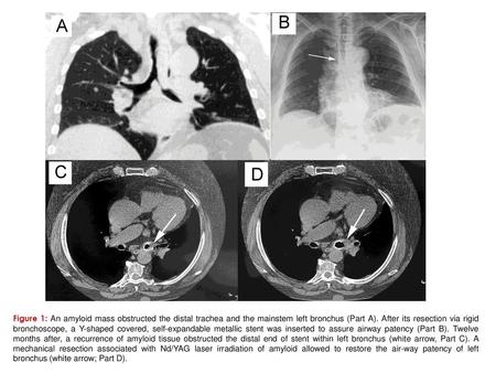 Figure 1: An amyloid mass obstructed the distal trachea and the mainstem left bronchus (Part A). After its resection via rigid bronchoscope, a Y-shaped.