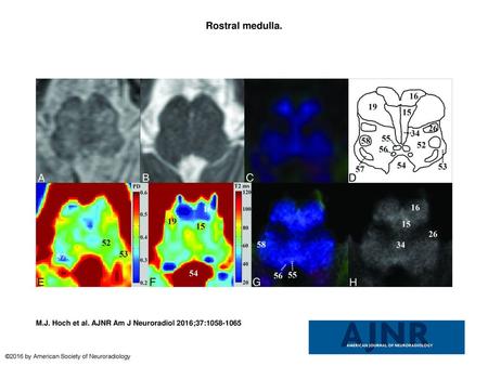 Rostral medulla. Rostral medulla. Upper row: A, Proton-density weighted. B, T2-weighted. C, DEC-DTI. D, Anatomic schematic. Lower row: E, EMC PD map. F,