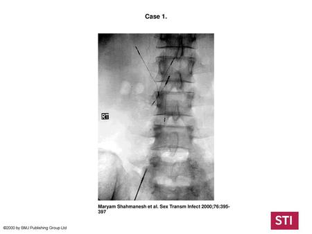 Case 1. Case 1. Radiograph showing bird's nest filter in place in inferior vena cava. The filter consists of two V-shaped stainless steel semirigid struts.