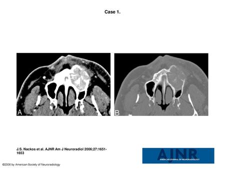 Case 1. Case 1. Images in a 51-year-old man with a history of painful maxillary swelling caused by GCG.A, Contrast-enhanced axial CT image demonstrates.