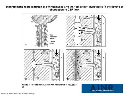 Diagrammatic representation of syringomyelia and the “presyrinx” hypothesis in the setting of obstruction to CSF flow. Diagrammatic representation of syringomyelia.