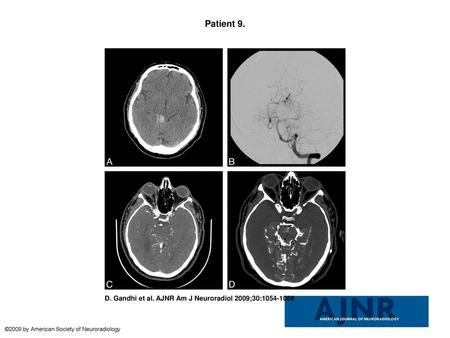 Patient 9. Patient 9. This patient is a 56-year-old man who presented with acute-onset headache and sudden neurologic deficits. A, Noncontrast CT scan.