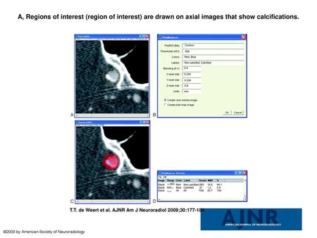 A, Regions of interest (region of interest) are drawn on axial images that show calcifications. A, Regions of interest (region of interest) are drawn on.