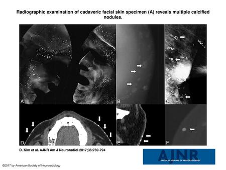 Radiographic examination of cadaveric facial skin specimen (A) reveals multiple calcified nodules. Radiographic examination of cadaveric facial skin specimen.