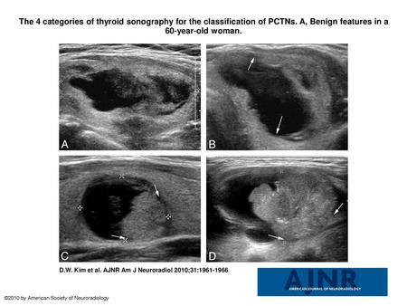 The 4 categories of thyroid sonography for the classification of PCTNs