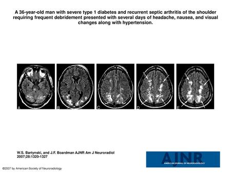 A 36-year-old man with severe type 1 diabetes and recurrent septic arthritis of the shoulder requiring frequent debridement presented with several days.