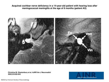 Acquired cochlear nerve deficiency in a 14-year-old patient with hearing loss after meningococcal meningitis at the age of 6 months (patient A3). Acquired.