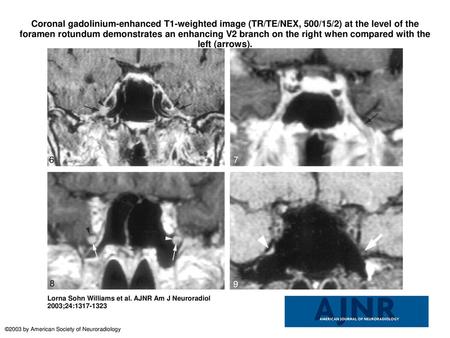 Coronal gadolinium-enhanced T1-weighted image (TR/TE/NEX, 500/15/2) at the level of the foramen rotundum demonstrates an enhancing V2 branch on the right.