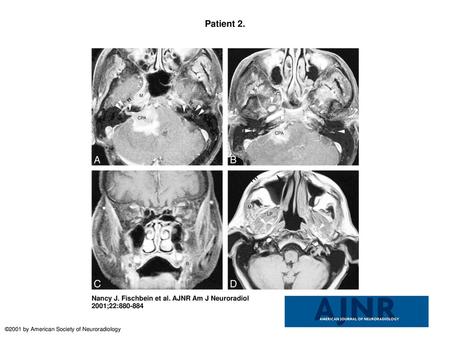 Patient 2. Patient 2. A, An axial T1-weighted postcontrast image with fat saturation (600/13/2) demonstrates an irregular mass centered at the right cerebellopontine.