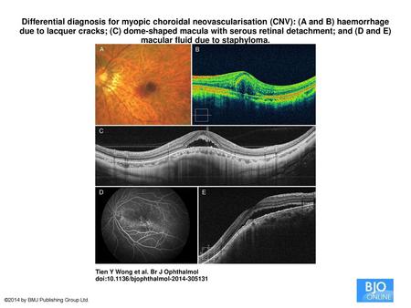 Differential diagnosis for myopic choroidal neovascularisation (CNV): (A and B) haemorrhage due to lacquer cracks; (C) dome-shaped macula with serous retinal.