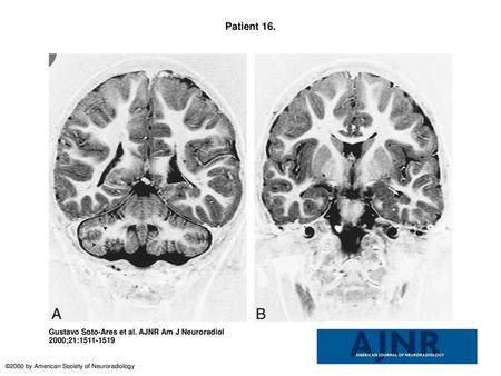 Patient 16. Patient 16. MR imaging findings in a 4-year-old boy with microcephalia, motor delay, and facial deformities. A, Coronal IR T1-weighted image.