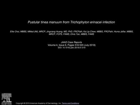 Pustular tinea manuum from Trichophyton erinacei infection