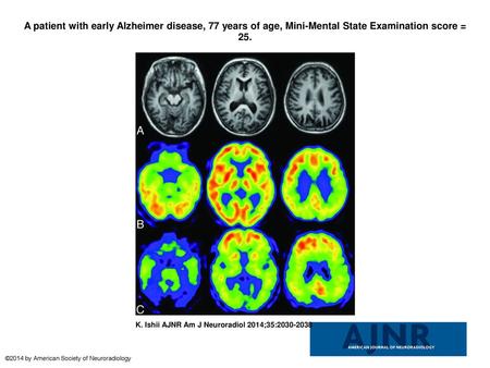 A patient with early Alzheimer disease, 77 years of age, Mini-Mental State Examination score = 25. A patient with early Alzheimer disease, 77 years of.