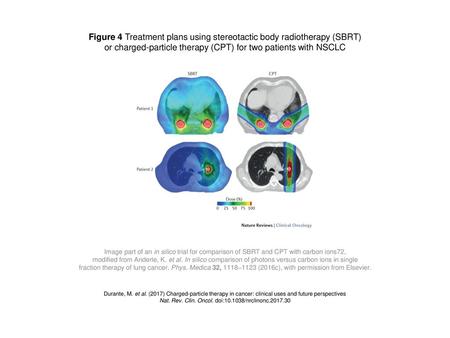 Figure 4 Treatment plans using stereotactic body radiotherapy (SBRT)