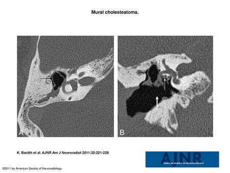 Mural cholesteatoma. Mural cholesteatoma. Axial (A) and coronal (B) HRCT scans show the shell of the cholesteatoma in the epitympanum (black arrow) and.