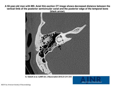 A 50-year-old man with MD. Axial thin-section CT image shows decreased distance between the vertical limb of the posterior semicircular canal and the posterior.