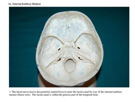 1a. Internal Auditory Meatus