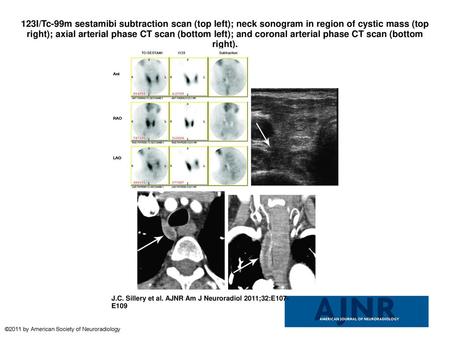 123I/Tc-99m sestamibi subtraction scan (top left); neck sonogram in region of cystic mass (top right); axial arterial phase CT scan (bottom left); and.