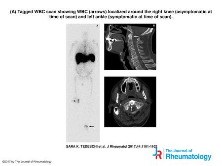 (A) Tagged WBC scan showing WBC (arrows) localized around the right knee (asymptomatic at time of scan) and left ankle (symptomatic at time of scan). (A)