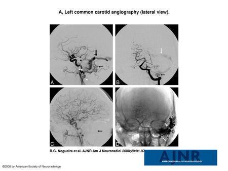 A, Left common carotid angiography (lateral view).