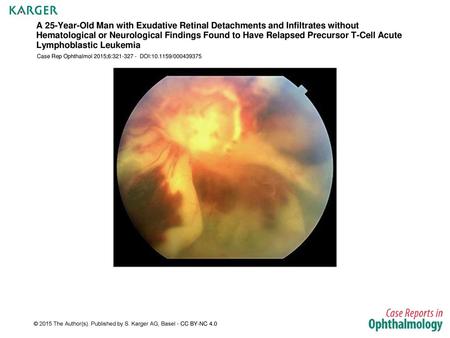 A 25-Year-Old Man with Exudative Retinal Detachments and Infiltrates without Hematological or Neurological Findings Found to Have Relapsed Precursor T-Cell.