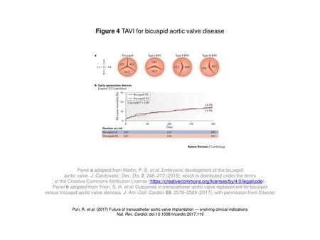 Figure 4 TAVI for bicuspid aortic valve disease