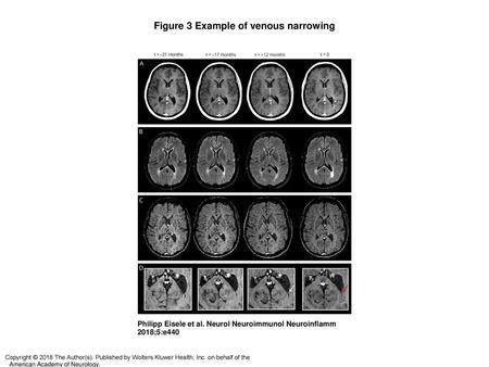 Figure 3 Example of venous narrowing