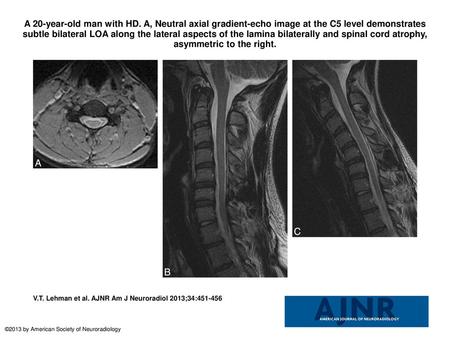 A 20-year-old man with HD. A, Neutral axial gradient-echo image at the C5 level demonstrates subtle bilateral LOA along the lateral aspects of the lamina.