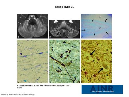 Case 5 (type 3). Case 5 (type 3). A and B, Postmortem axial (A) and coronal (B) T2-weighted images show atrophied cerebellar cortices with dilation of.