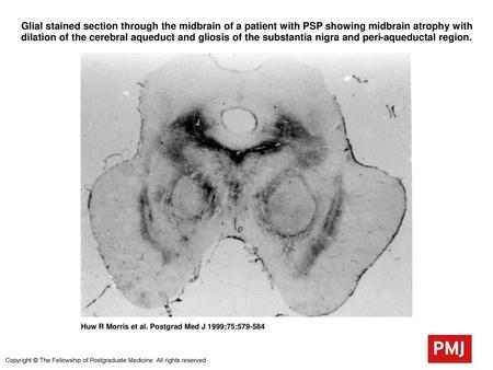 Glial stained section through the midbrain of a patient with PSP showing midbrain atrophy with dilation of the cerebral aqueduct and gliosis of the substantia.