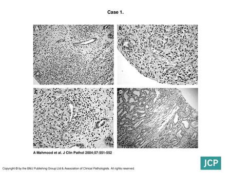 Case 1. Case 1. (A) Low power photomicrograph of renal medulla showing a poorly formed granuloma with several disrupted and destroyed renal tubules within.