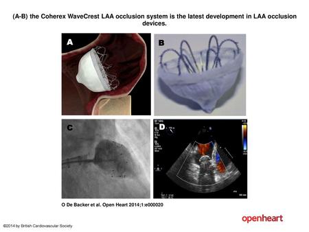 (A-B) the Coherex WaveCrest LAA occlusion system is the latest development in LAA occlusion devices. (A-B) the Coherex WaveCrest LAA occlusion system is.