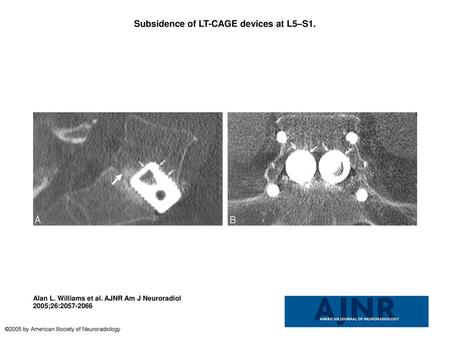 Subsidence of LT-CAGE devices at L5–S1.