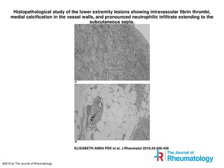 Histopathological study of the lower extremity lesions showing intravascular fibrin thrombi, medial calcification in the vessel walls, and pronounced neutrophilic.