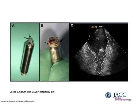 Jacob S. Koruth et al. JACEP 2015;1: