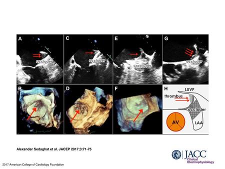 Alexander Sedaghat et al. JACEP 2017;3:71-75