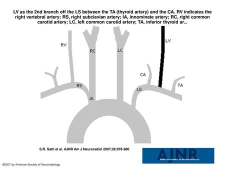 LV as the 2nd branch off the LS between the TA (thyroid artery) and the CA. RV indicates the right vertebral artery; RS, right subclavian artery; IA, innominate.