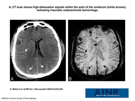 A, CT scan shows high-attenuation signals within the sulci of the cerebrum (white arrows), indicating traumatic subarachnoid hemorrhage. A, CT scan shows.