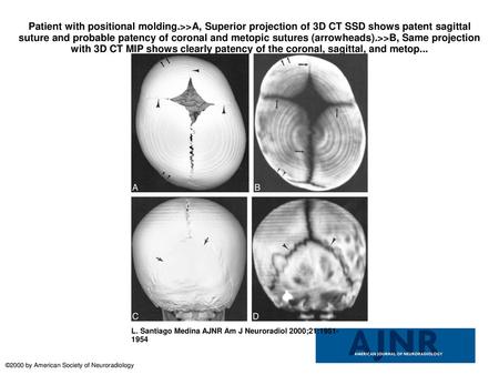 Patient with positional molding