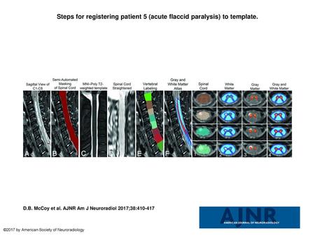 Steps for registering patient 5 (acute flaccid paralysis) to template.