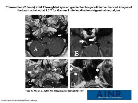 Thin-section (2.5-mm) axial T1-weighted spoiled gradient-echo gadolinium-enhanced images of the brain obtained at 1.5 T for Gamma knife localization (trigeminal.