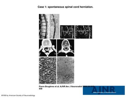 Case 1: spontaneous spinal cord herniation.