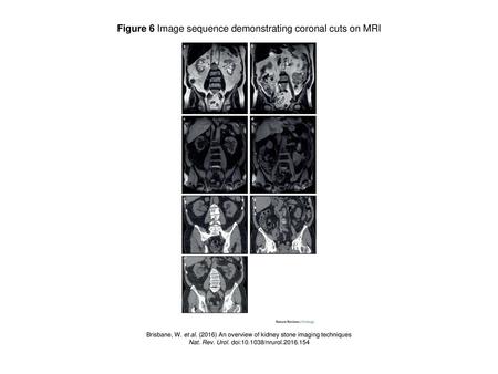 Figure 6 Image sequence demonstrating coronal cuts on MRI