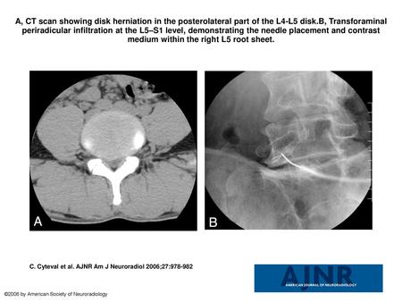 A, CT scan showing disk herniation in the posterolateral part of the L4-L5 disk.B, Transforaminal periradicular infiltration at the L5–S1 level, demonstrating.