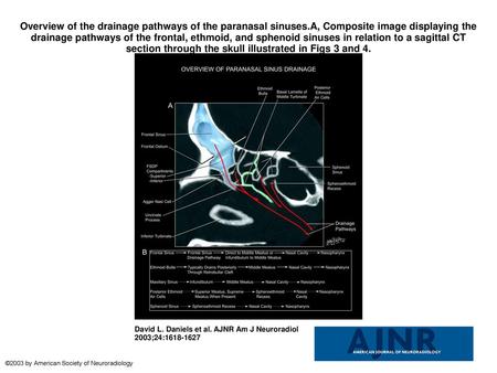 Overview of the drainage pathways of the paranasal sinuses