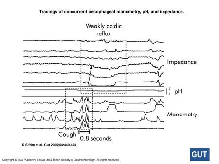 Tracings of concurrent oesophageal manometry, pH, and impedance.